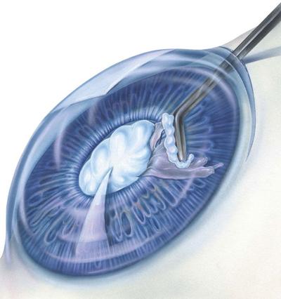 lookingintocataracts.jpg